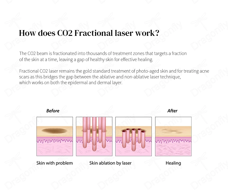 2023 Professional CO2 20% off Vaginal Tightening Laser/Fractional CO2 Laser Beauty Salon Machine