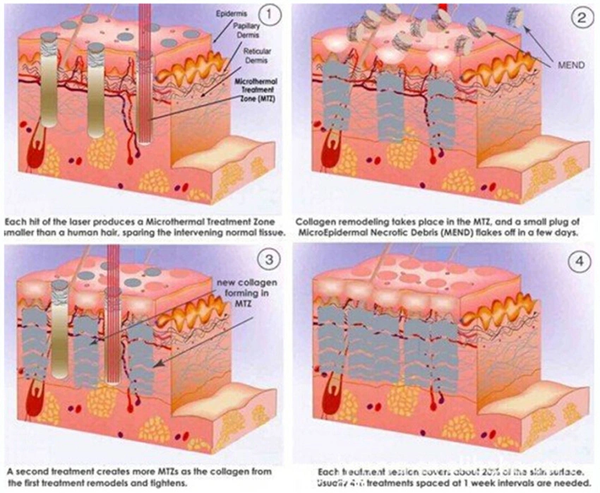 professional RF Tube 3D 4D Fractional CO2 Laser for Skin Resurfacing Vaginal Tightening Marks Acne Scar Removal with Training